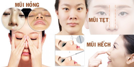 Nâng mũi cấu trúc uy tín nhất ở đâu (2)